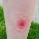 Why_Traditional_Antibiotics_Fail_Chronic_Lyme_Disease.jpg
